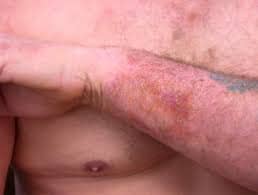 contact dermatitis from epoxy resin