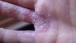 epoxy resin eczema
