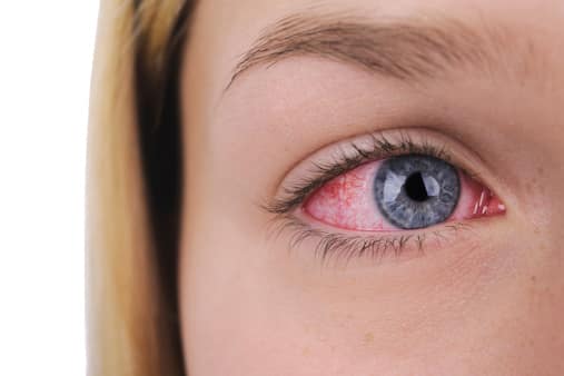 eye irritation from epoxy resin